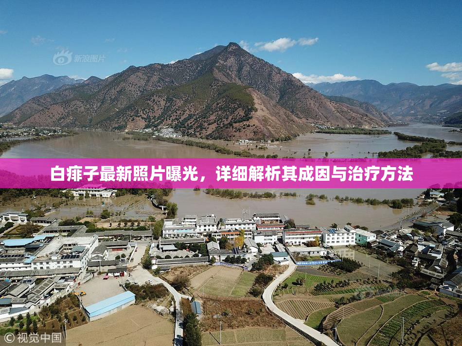 白痱子最新照片曝光，详细解析其成因与治疗方法